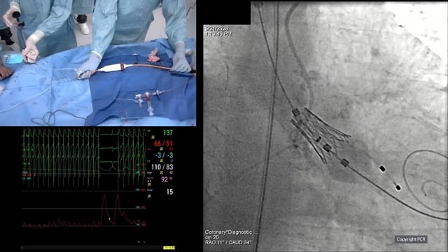 Real world practice inspiring new evidence generation in structural heart