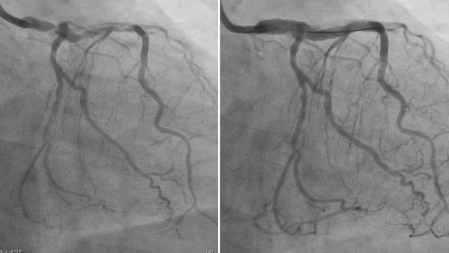 Rescue techniques for coronary interventions