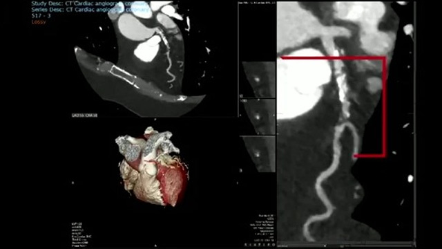 Reshaping what's possible in complex PCI with advanced sirolimus technology