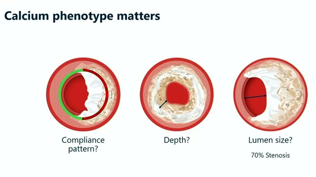 Simplify the complex with Shockwave C2 Aero - Next-generation coronary intravascular lithotripsy that delivers