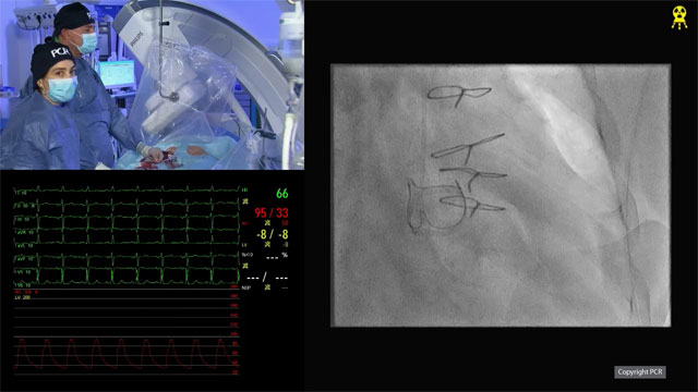 TAV-in-SAV TAVI procedure - LIVE case