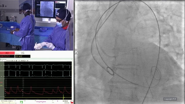 TAVI and coronary artery disease - LIVE case