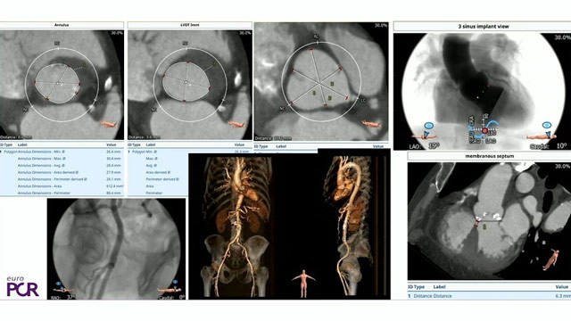 TAVI and coronary artery disease: we need the COMPLETE answer!