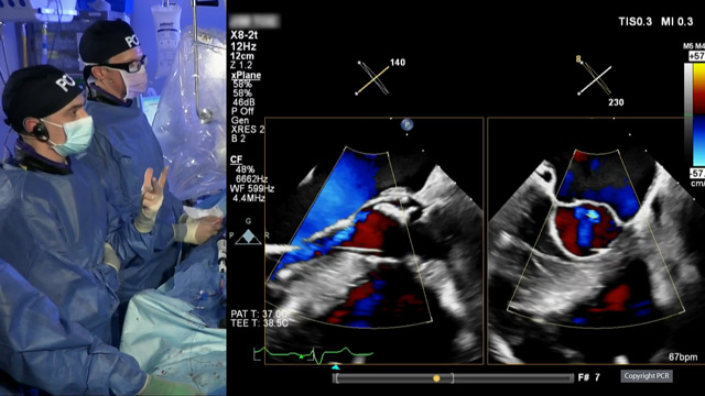 Is durability still a topic of concern for TAVI patients? What are the remaining challenges that we need to overcome?