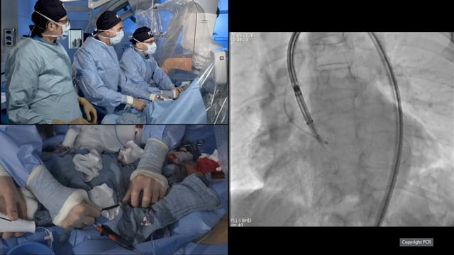 TAVI in aortic regurgitation with a dedicated valve - LIVE case