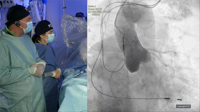 TAVI in extensive valve calcifications - LIVE case