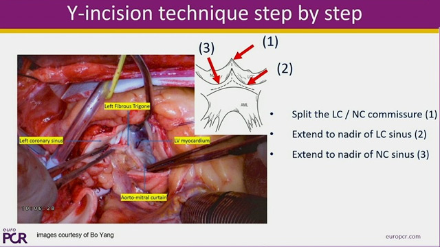 TAVI vs. surgery - Are the latest long-term data creating a dilemma for aortic stenosis patients?