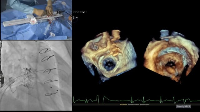Transcatheter mitral valve replacement - LIVE case