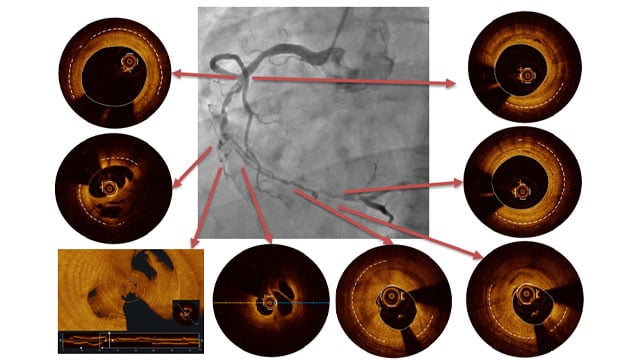 Uncovering ischaemia mechanisms with intracoronary imaging