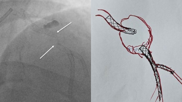 Unusual complexities, uncommon complications and innovative solutions