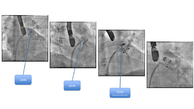 When transcatheter LAA closure becomes challenging