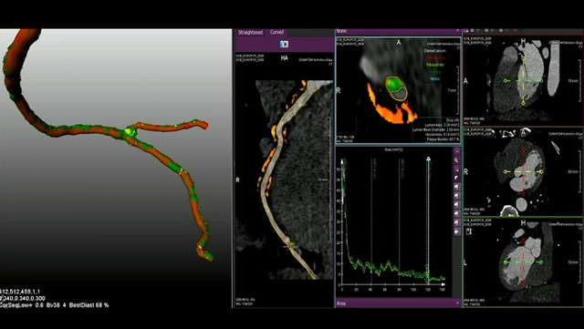 Where to leave less behind: non-invasive CT and angiography-derived physiology for DCB lesion selection