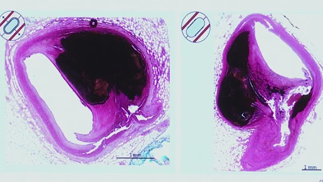 Introducing next era of coronary intravascular lithotripsy: aero-volution in calcium modification