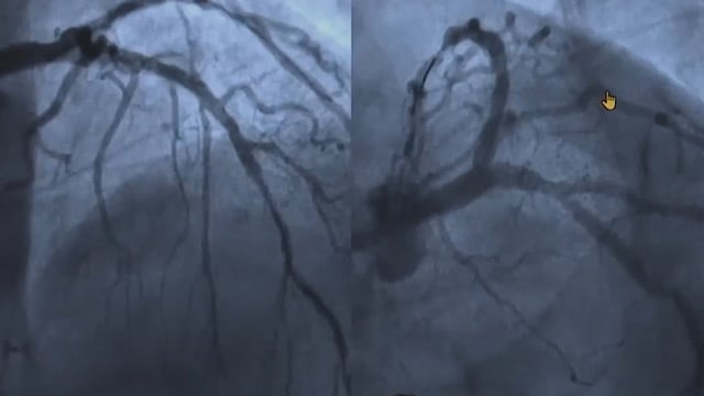 It is a calcified left main: do it well, do it safely