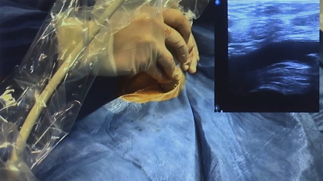 Mechanical circulatory support protected PCI in complex calcified patients