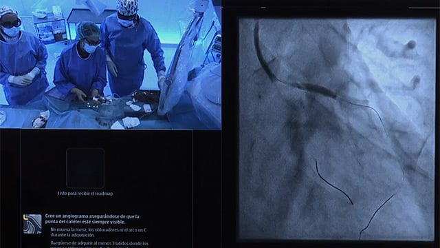 Novel Hertz Contact intravascular lithotripsy: calcium fragmentation with zero trade-offs