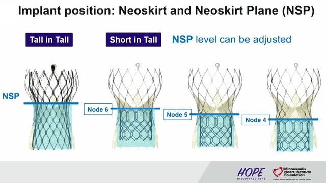 All you need to know about redo TAVI