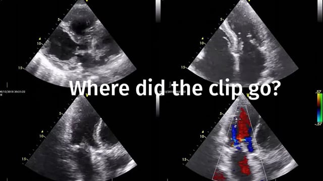 Complications and bailout strategies in transcatheter mitral interventions