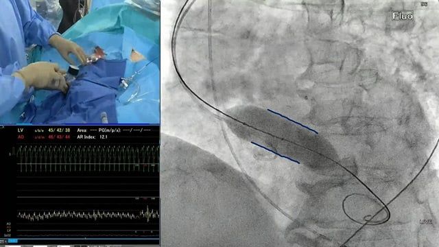 Coronary access and revascularisation in patients undergoing TAVI: from work-up to lifetime management