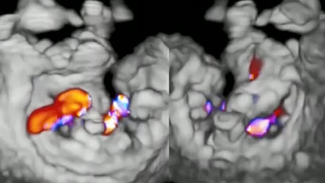 From diagnosis to device: decision-making and planning for mitral valve interventions