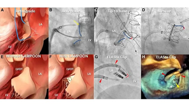 Future devices and techniques for structural heart disease