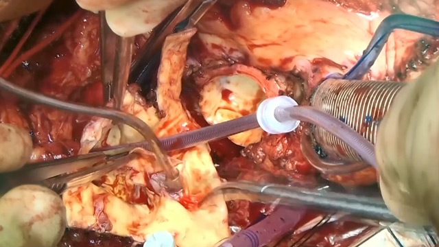 Learn from the experts: Evolut first implant technique and treatment strategies