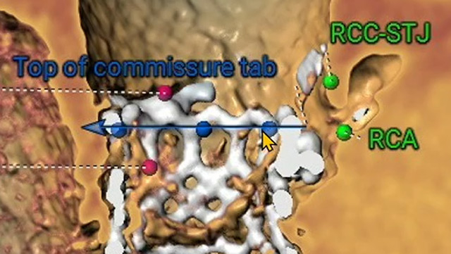 Learn from the experts: lifetime management for Evolut first redo TAVI (TAV-in-TAV) and explant