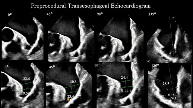 Mastering LAA closure: a step-by-step case experience