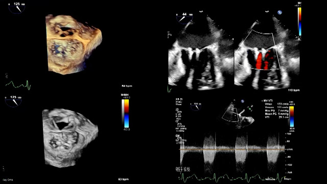Mastering mitral TEER: guidelines, complex cases, and Asia Pacific insights