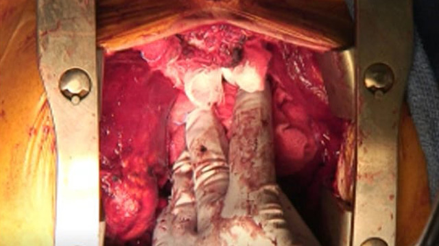 Mastering techniques from basic to complex - Avoidance and management of TAVI complications