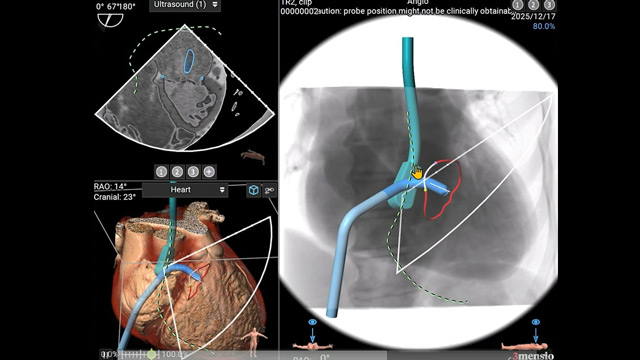 Mastering techniques from basic to complex - Mitral regurgitation assessment and suitability for TEER