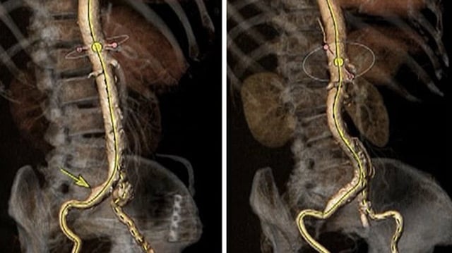 Mastering techniques from basic to complex - TAVI basics