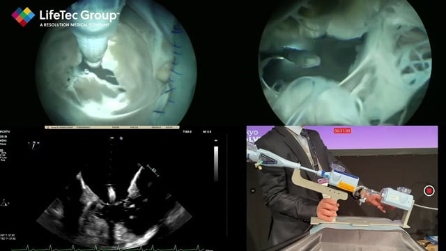 Mastering techniques from basic to complex - Tricuspid TEER fundamentals
