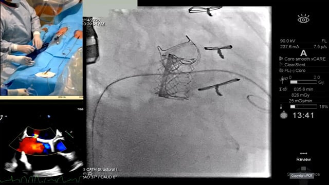 Mitral and aortic transcatheter valve-in-valve intervention - LIVE case