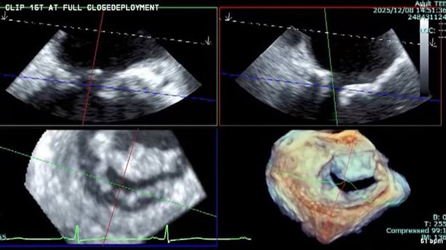 Mitral TEER masterclass