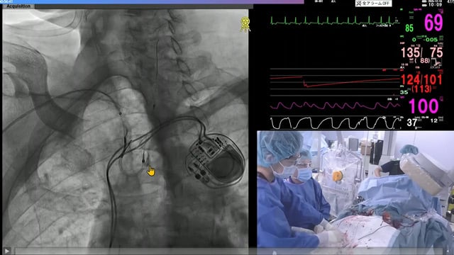 New horizons in structural heart disease therapy - Cutting-edge stroke prevention devices: WATCHMAN × SENTINEL