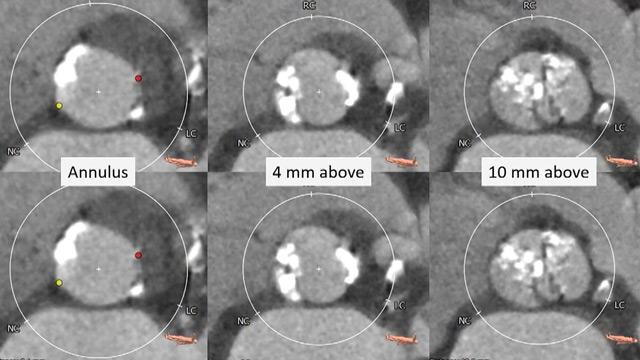 Patient-tailored treatment for bicuspid valve