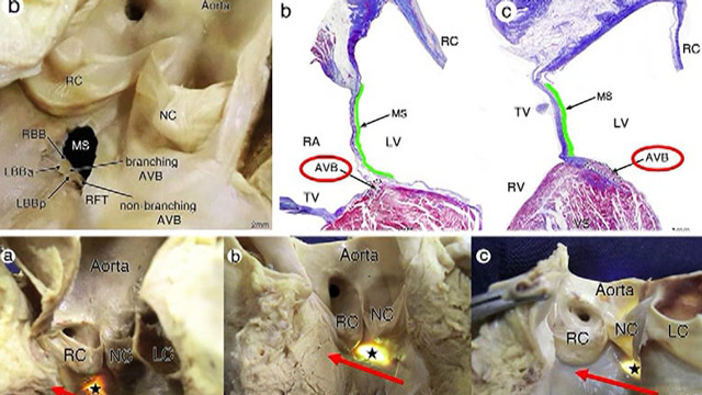 Prevention and management of TAVI complications