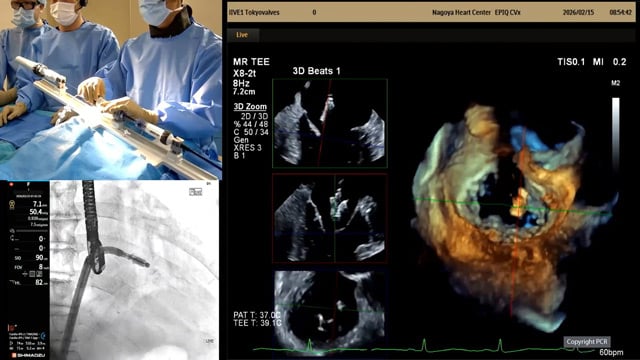 Primary mitral TEER in small anatomy - LIVE case