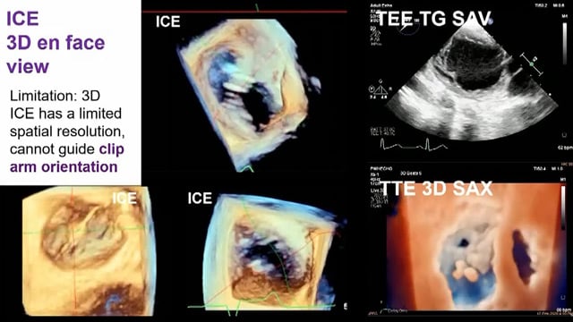 Procedural imaging for tricuspid valve interventions