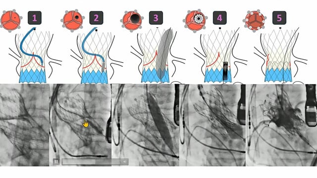 Transcatheter electrosurgery and leaflet modification of the aortic valve