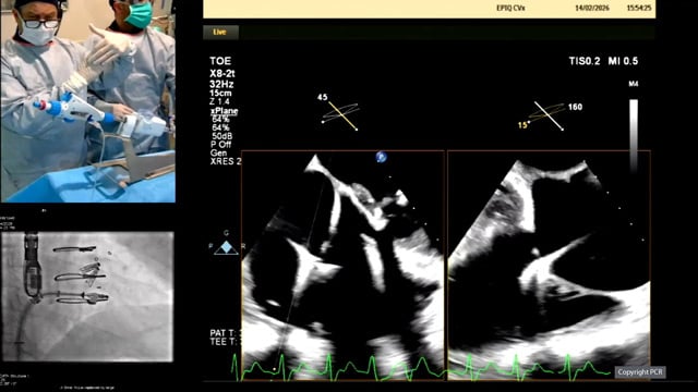 Tricuspid: LIVE Educational Case from The Prince Charles Hospital, Metro North Health - Brisbane, Australia