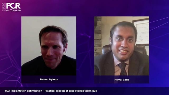 TAVI implantation optimisation – Practical aspects of cusp overlap technique