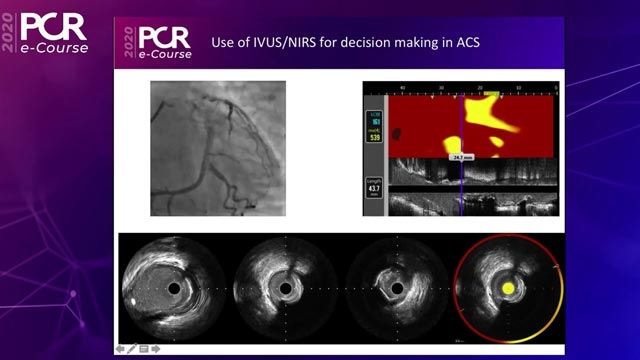 Use of IVUS+NIRS imaging for decision making in ACS
