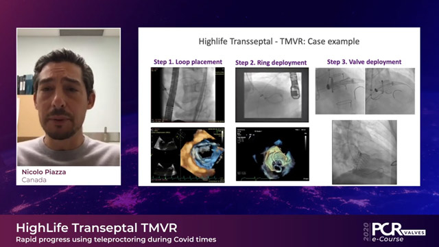 Transeptal TMVR: Rapid progress using teleproctoring during Covid times