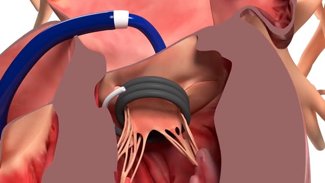 Repair and replace: latest insights in transcatheter treatment of mitral and tricuspid regurgitation