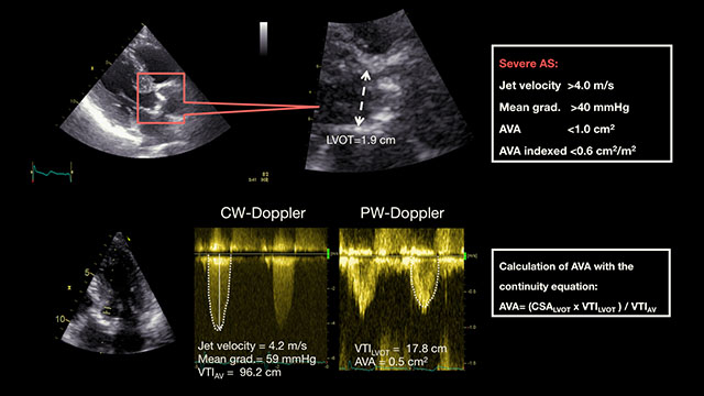 Pre-procedural imaging: patient selection