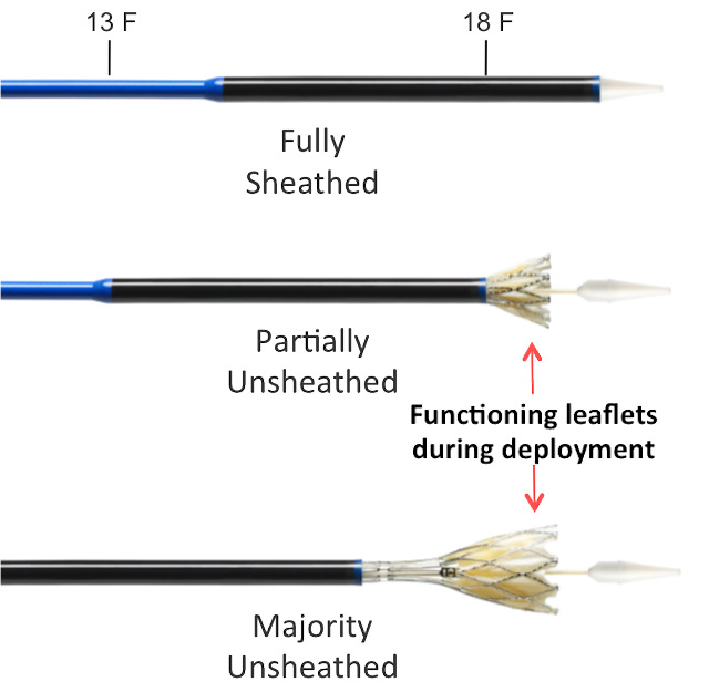 Figure 68. Abbott Portico Valve Delivery system diameter (3)