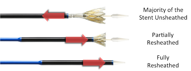 Figure 69. Abbott Portico Valve Delivery system diameter (4)