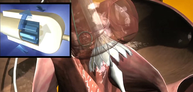 CoreValve® Evolut™ R